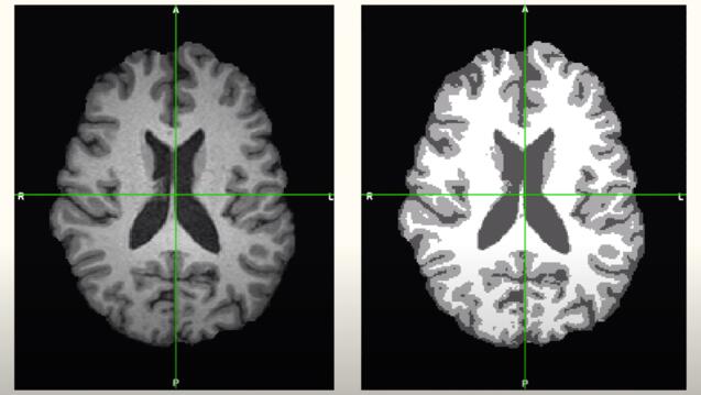 Side by side MRI scans of a brain